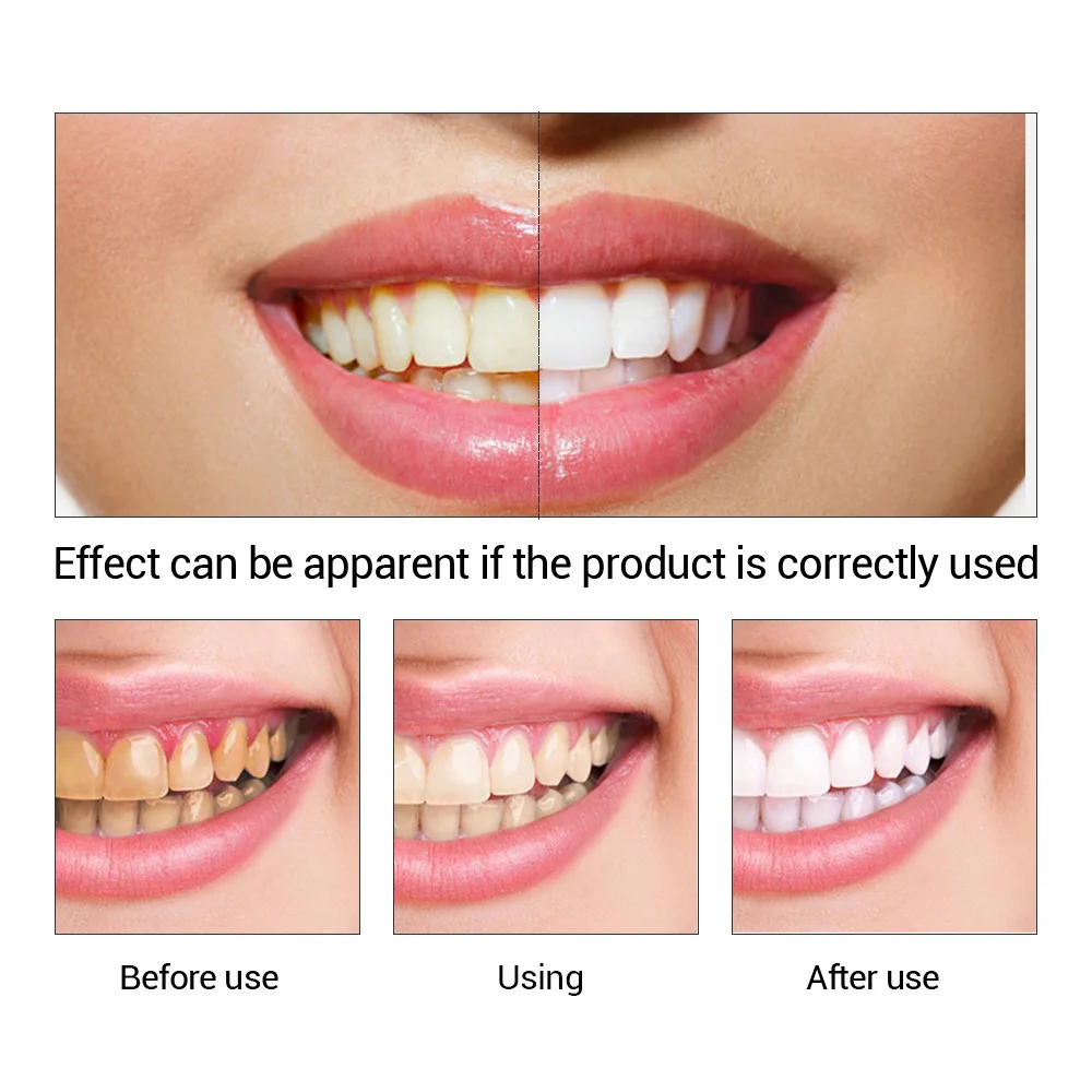 Fteenly تبييض الأسنان جوهر مسح - مراجعة Teeth Whitening Clinic وسعره