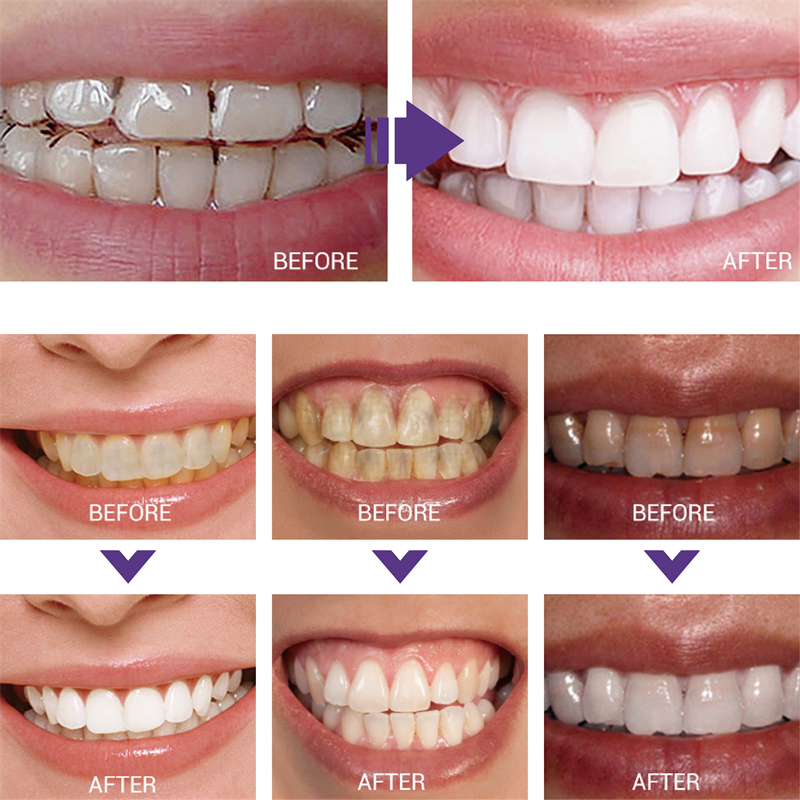 1 قطعة تنظيف الأسنان تبييض معج - مراجعة Teeth Whitening Korea وسعره
